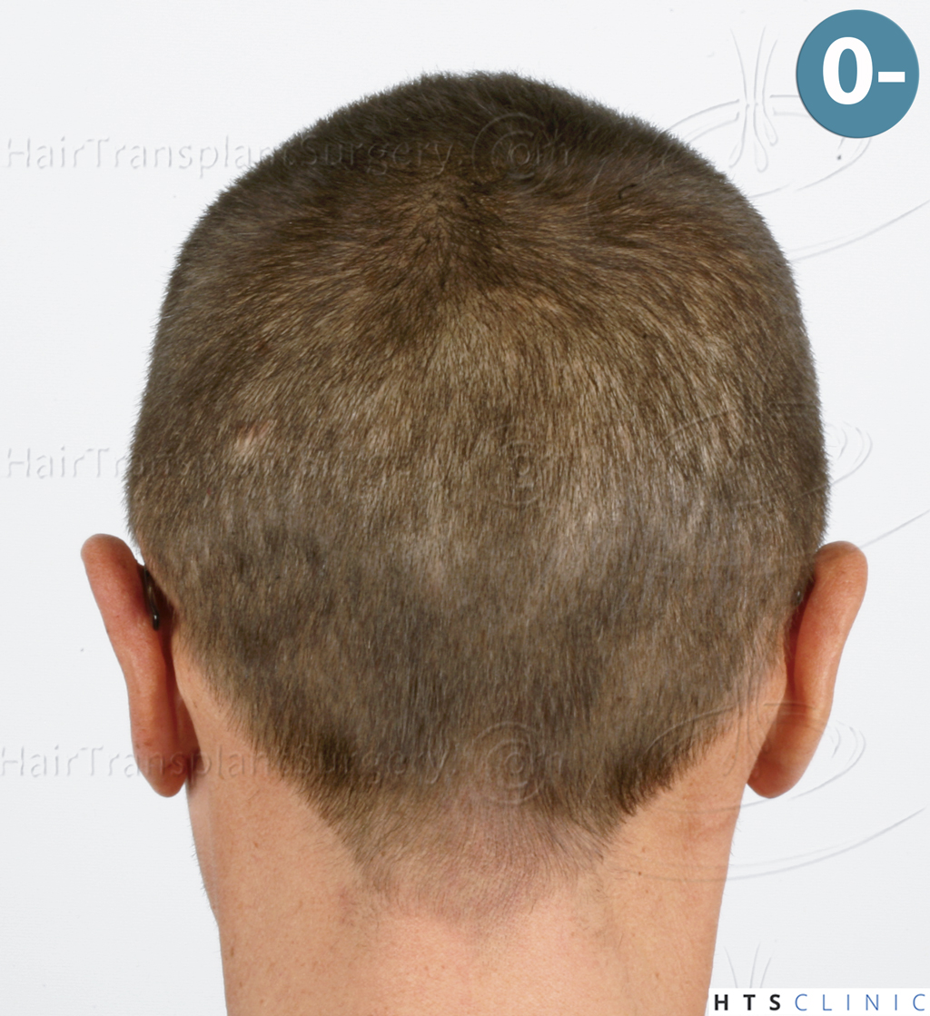 Dr.Devroye-HTS-Clinic-2950-FUE-NW-III-6