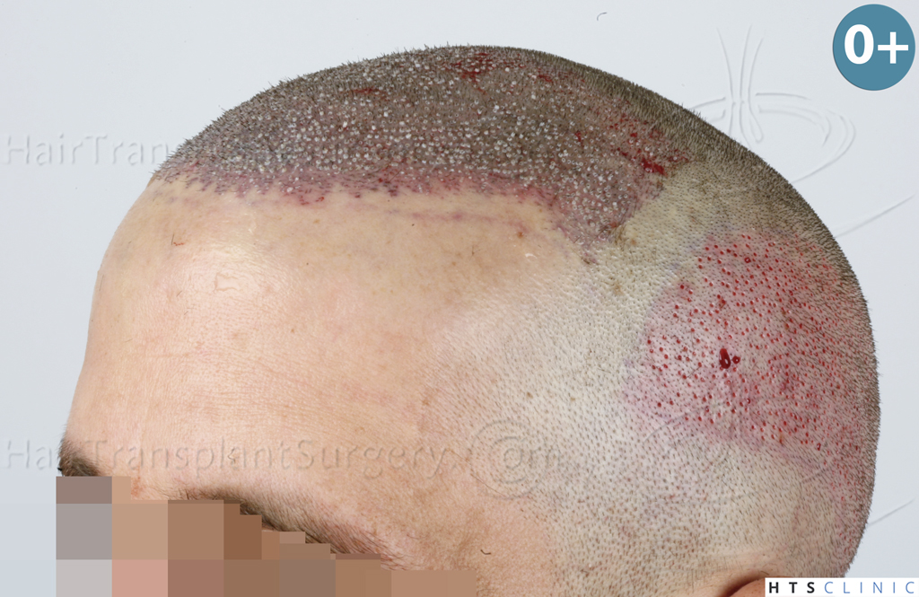 Dr.Devroye-HTS-Clinic-2950-FUE-NW-III-10