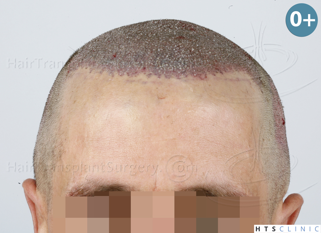 Dr.Devroye-HTS-Clinic-2950-FUE-NW-III-8