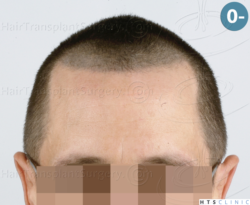 Dr.Devroye-HTS-Clinic-2950-FUE-NW-III-1