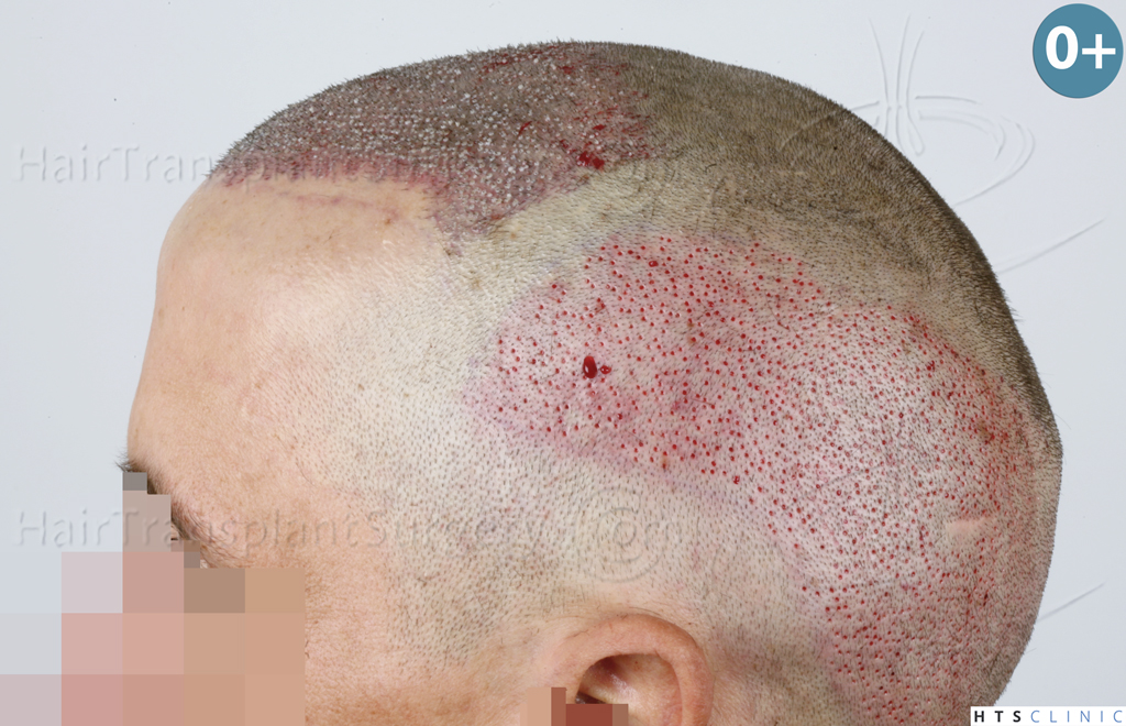 Dr.Devroye-HTS-Clinic-2950-FUE-NW-III-9