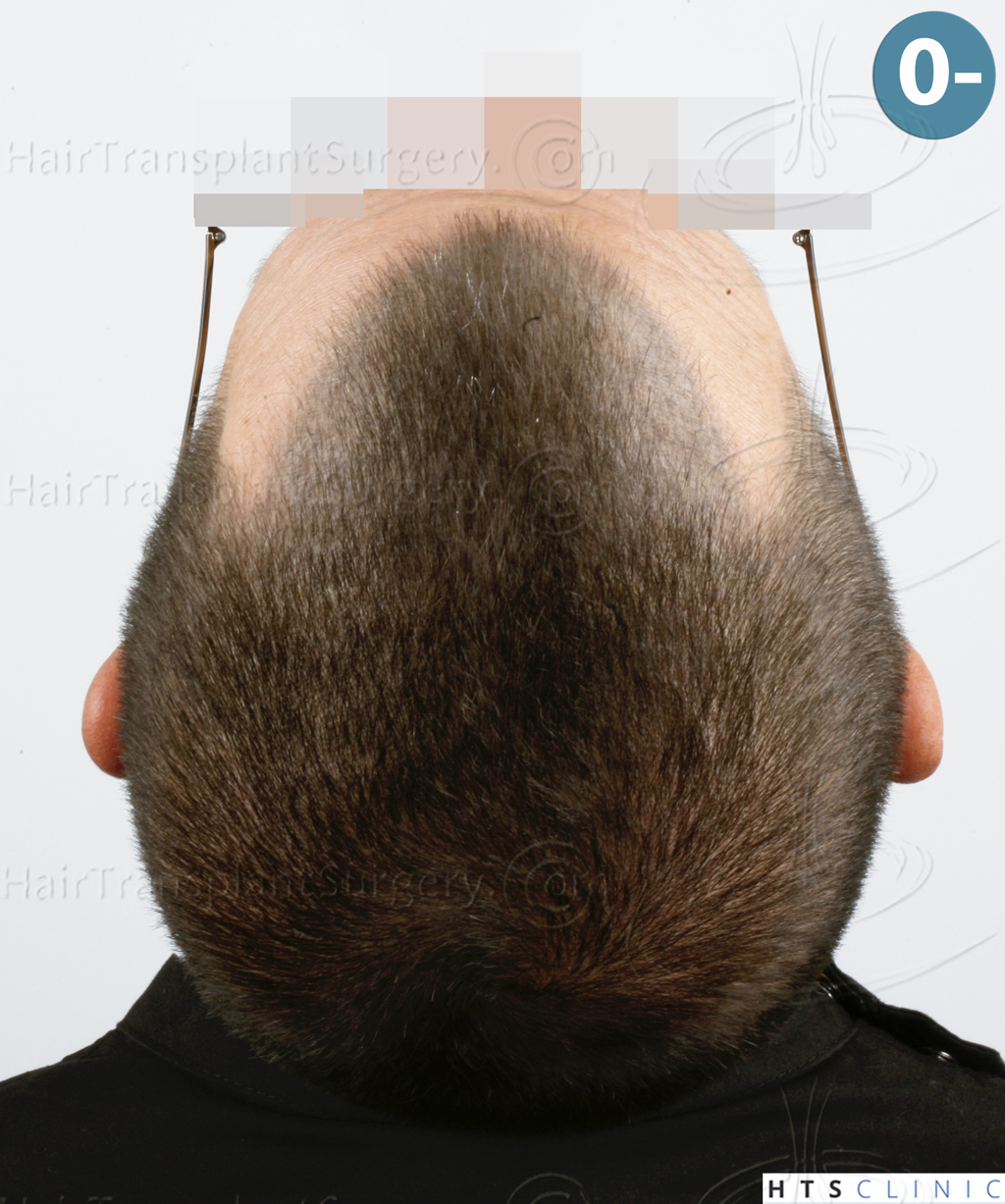 Dr.Devroye-HTS-Clinic-2950-FUE-NW-III-7.jpg