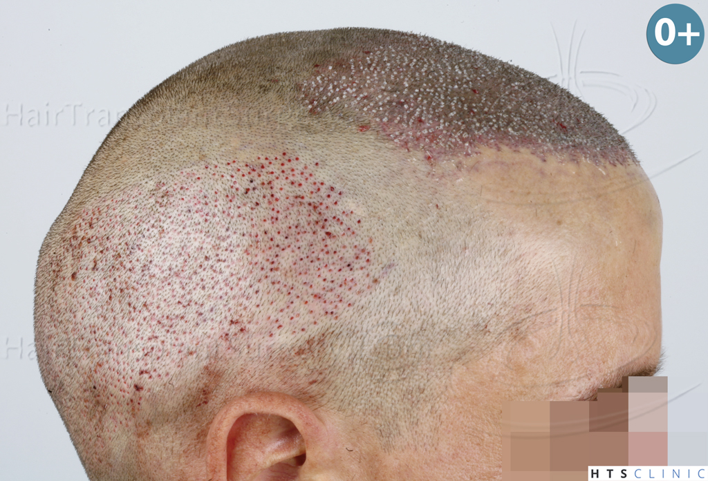 Dr.Devroye-HTS-Clinic-2950-FUE-NW-III-11