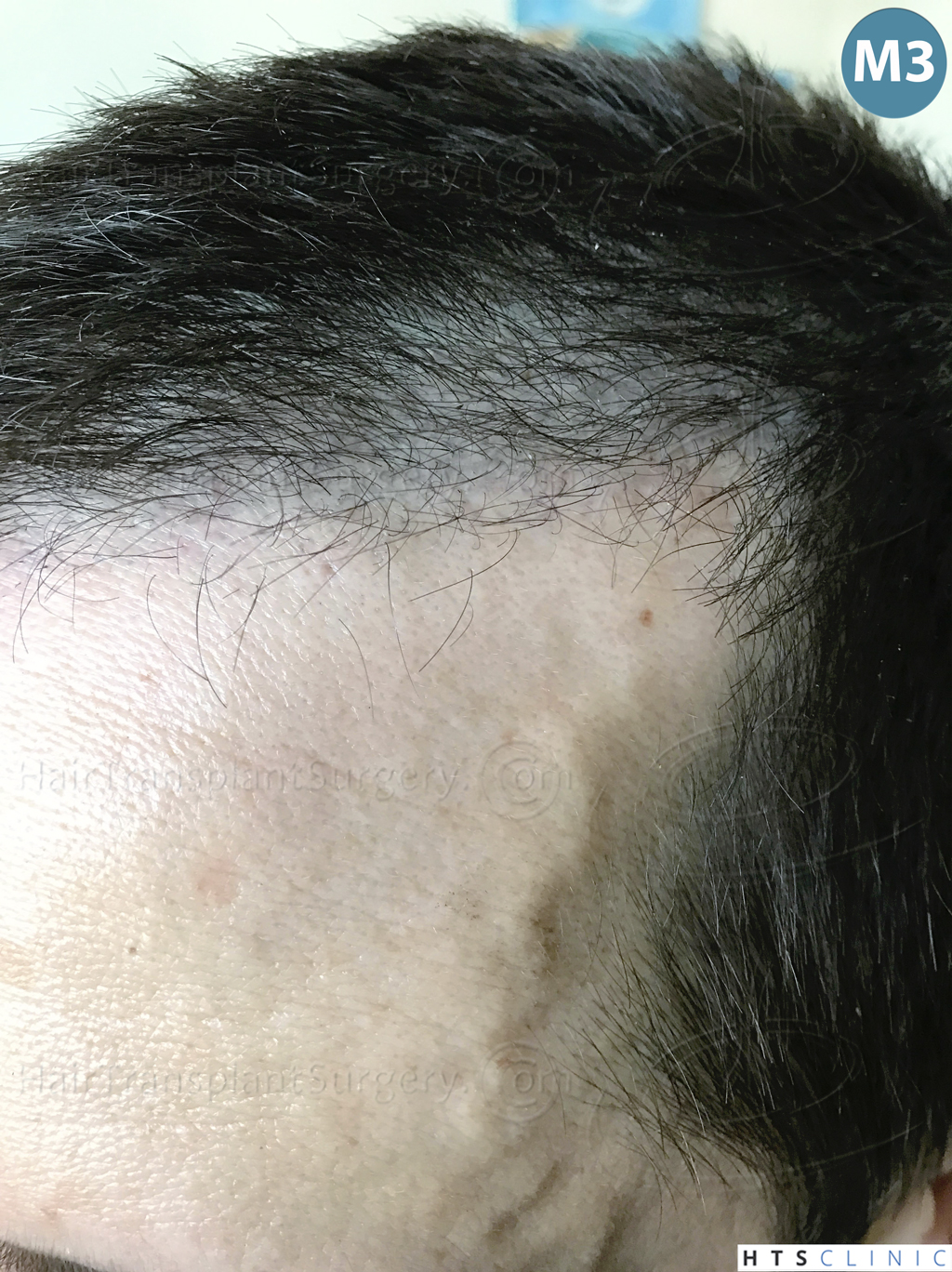 Dr.Devroye-HTS-Clinic-2950-FUE-NW-III-16