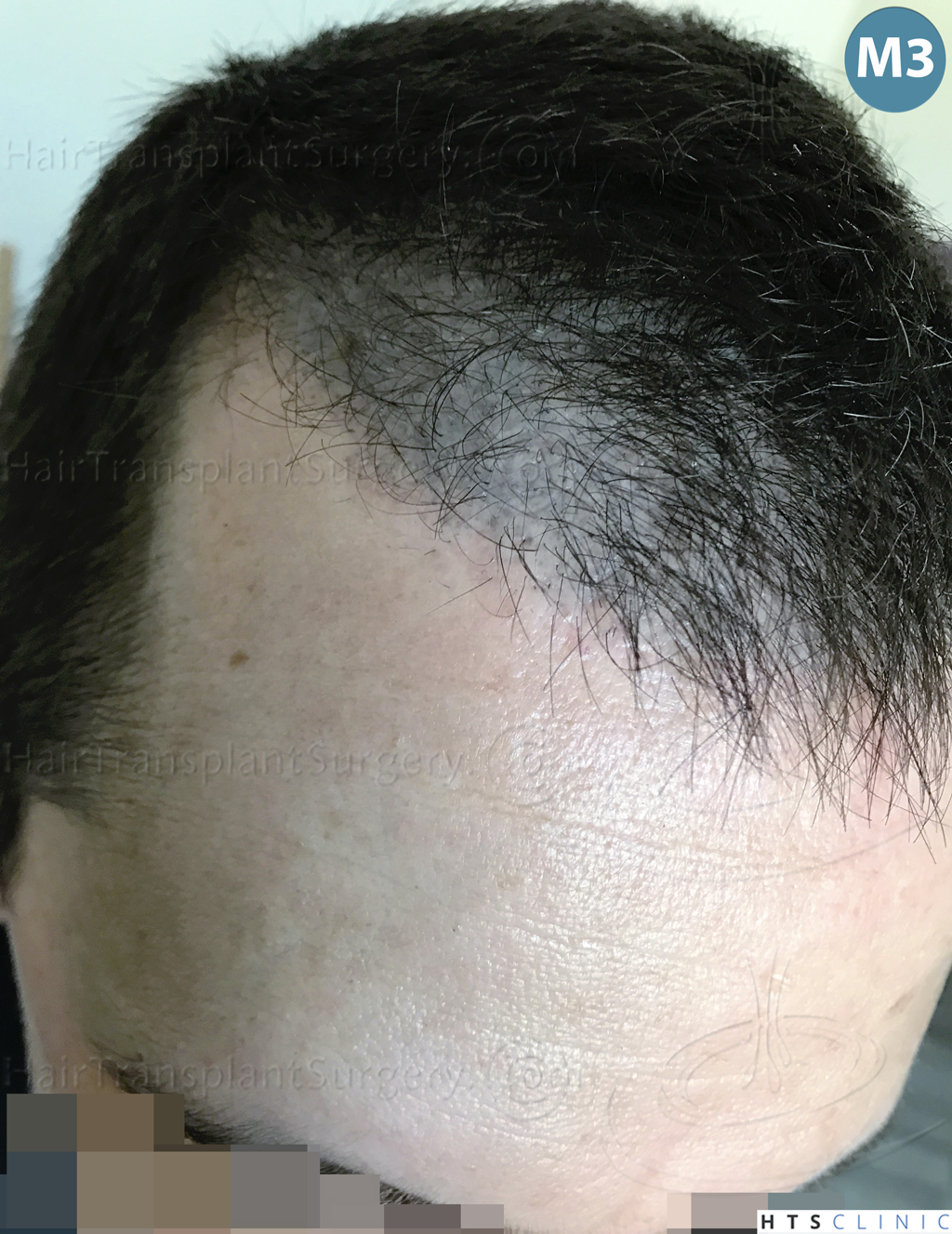 Dr.Devroye-HTS-Clinic-2950-FUE-NW-III-17.jpg