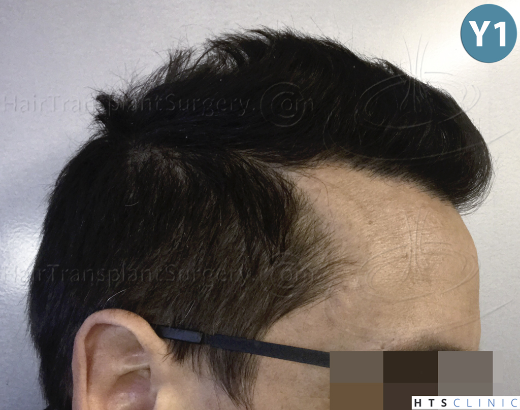 Dr.Devroye-HTS-Clinic-2950-FUE-NW-III-22