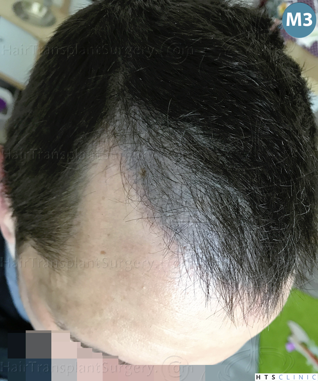 Dr.Devroye-HTS-Clinic-2950-FUE-NW-III-18