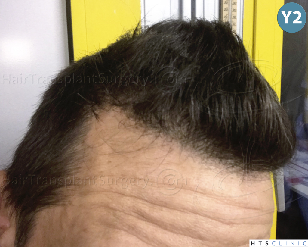 Dr.Devroye-HTS-Clinic-2950-FUE-NW-III-26