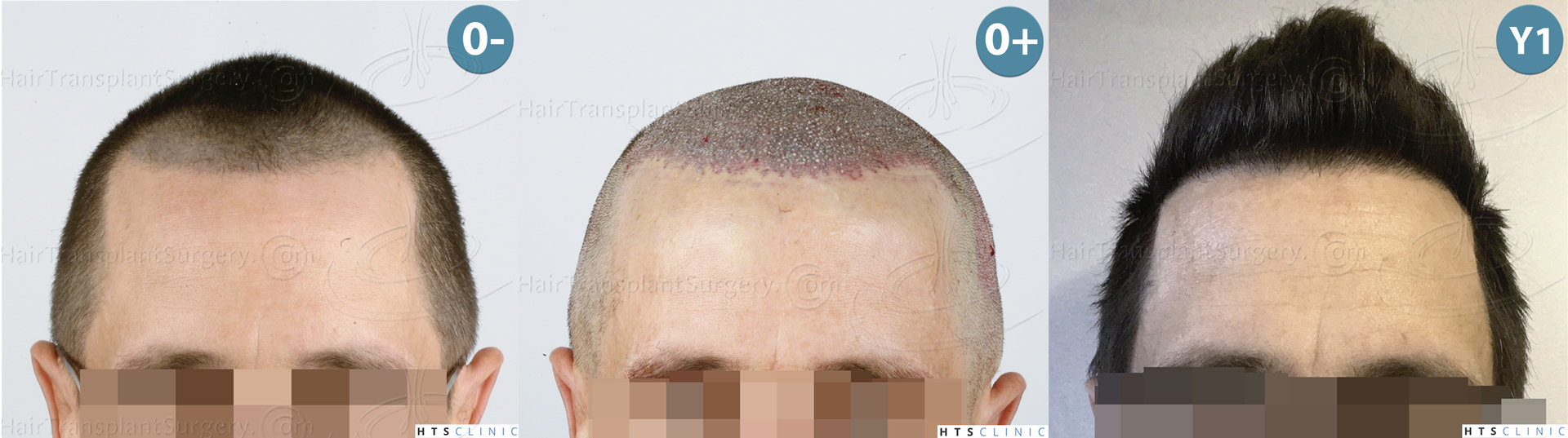 Dr.Devroye-HTS-Clinic-2950-FUE-NW-III-Montage-1