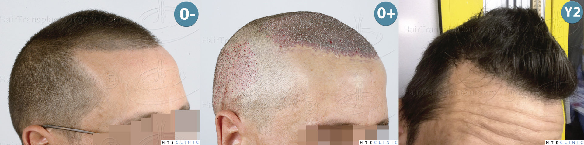 Dr.Devroye-HTS-Clinic-2950-FUE-NW-III-Montage-2