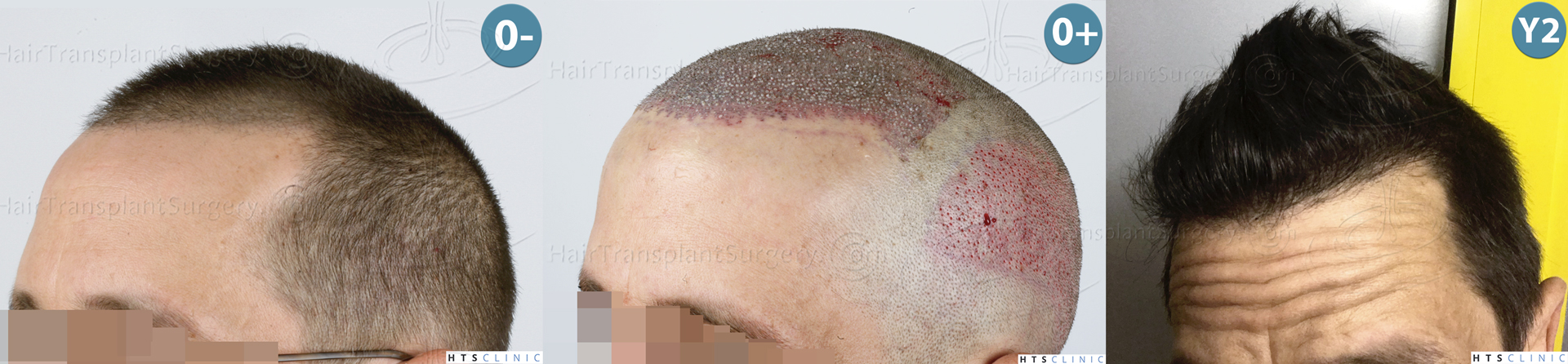 Dr.Devroye-HTS-Clinic-2950-FUE-NW-III-Montage-3.jpg