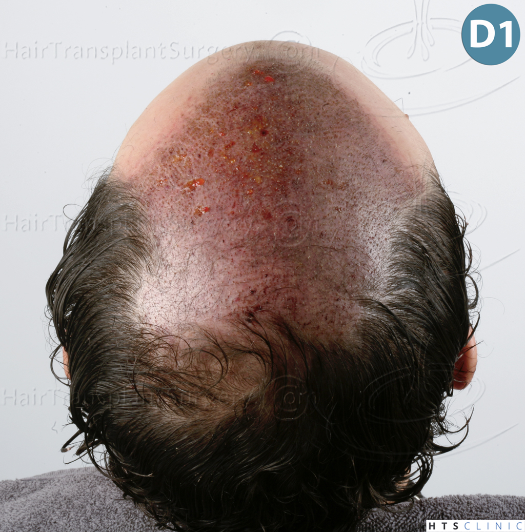 Dr.Devroye-HTS-Clinic-3920-FUT-12.jpg