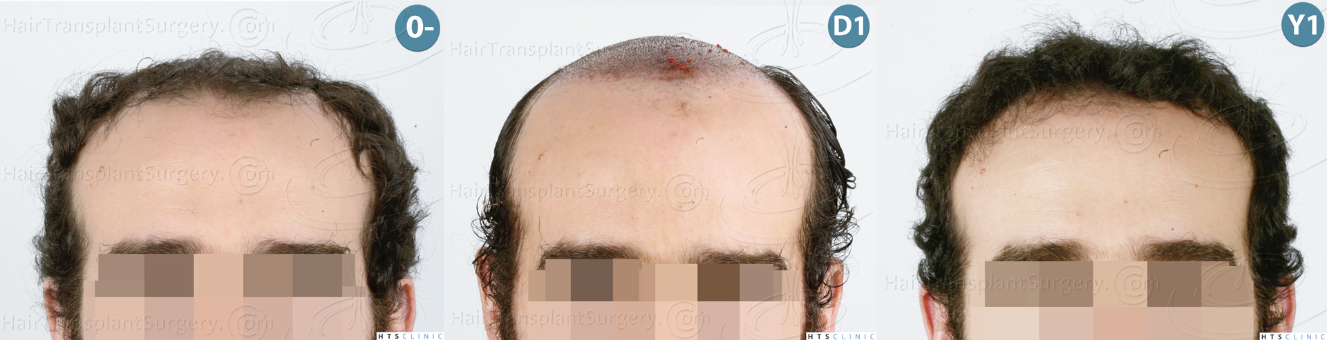 Dr.Devroye-HTS-Clinic-3920-FUT-Montage-1.jpg