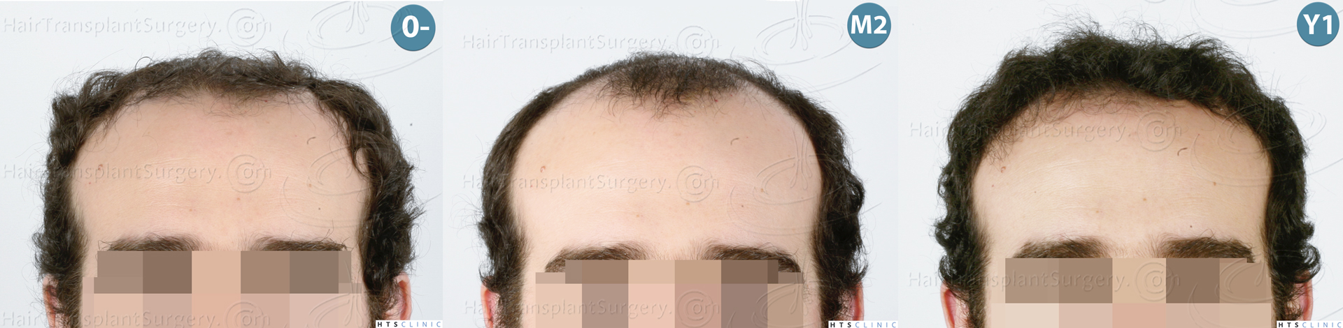 Dr.Devroye-HTS-Clinic-3920-FUT-Montage-2.jpg