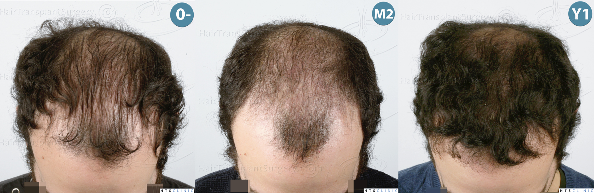 Dr.Devroye-HTS-Clinic-3920-FUT-Montage-4.jpg