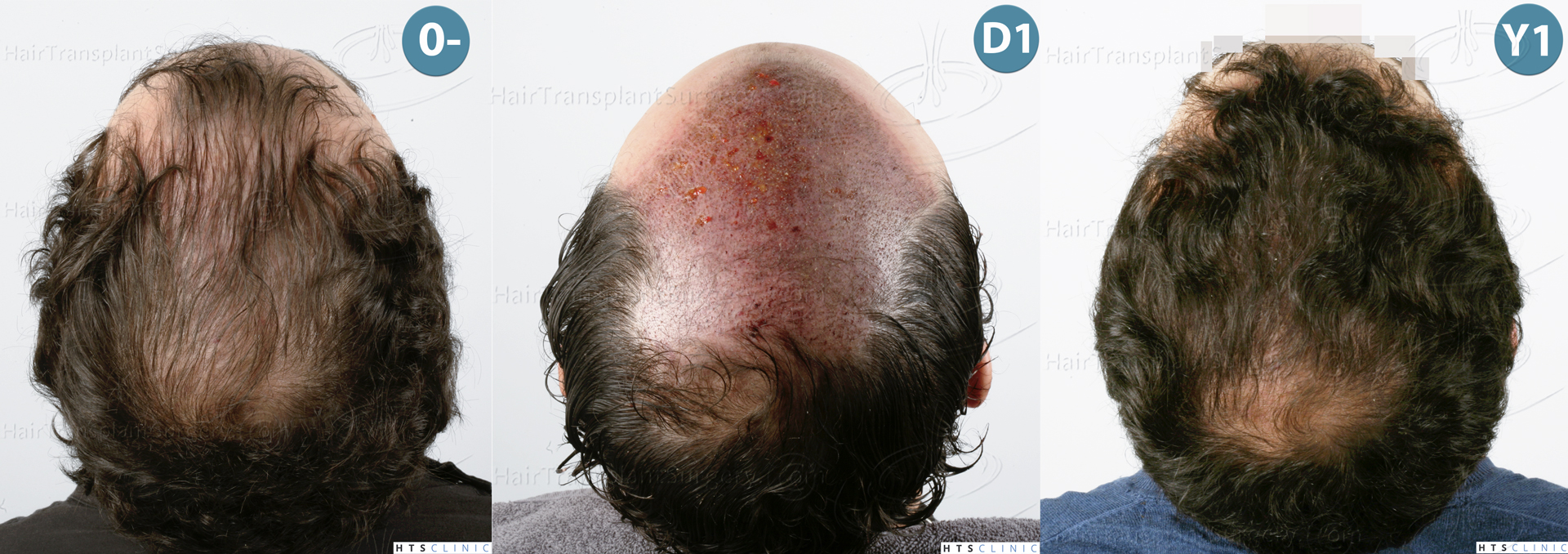 Dr.Devroye-HTS-Clinic-3920-FUT-Montage-5.jpg