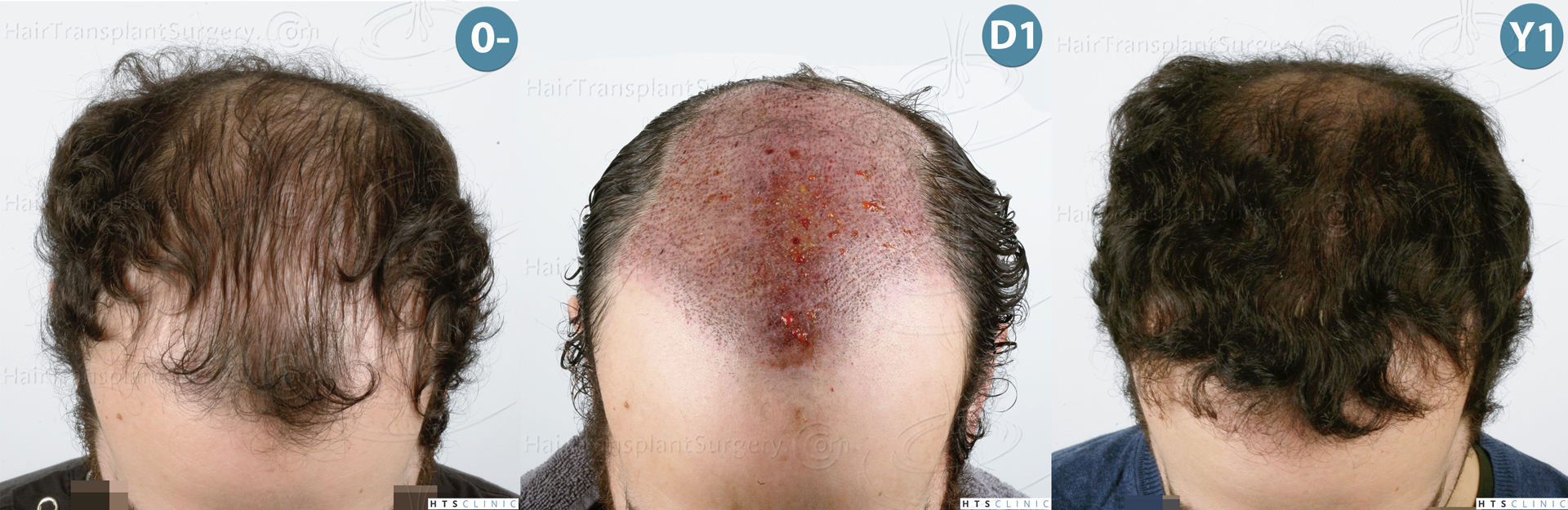 Dr.Devroye-HTS-Clinic-3920-FUT-Montage-3.jpg