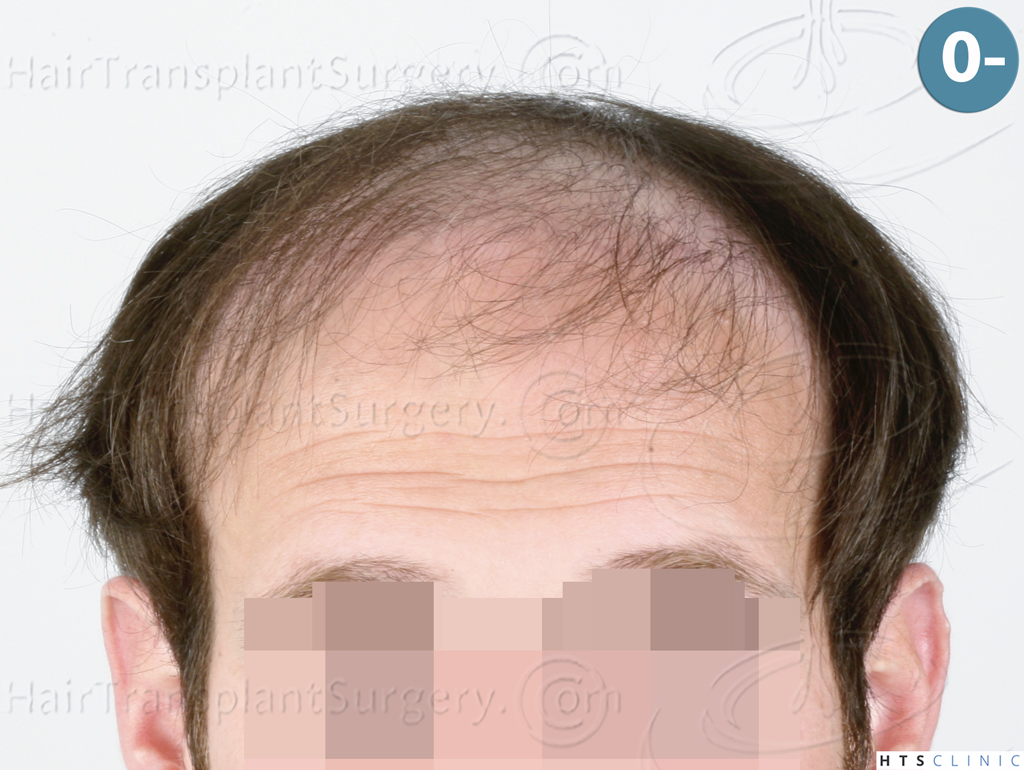 Dr.Devroye-HTS-Clinic-4510-Combo-FUT_FUE-1.jpg