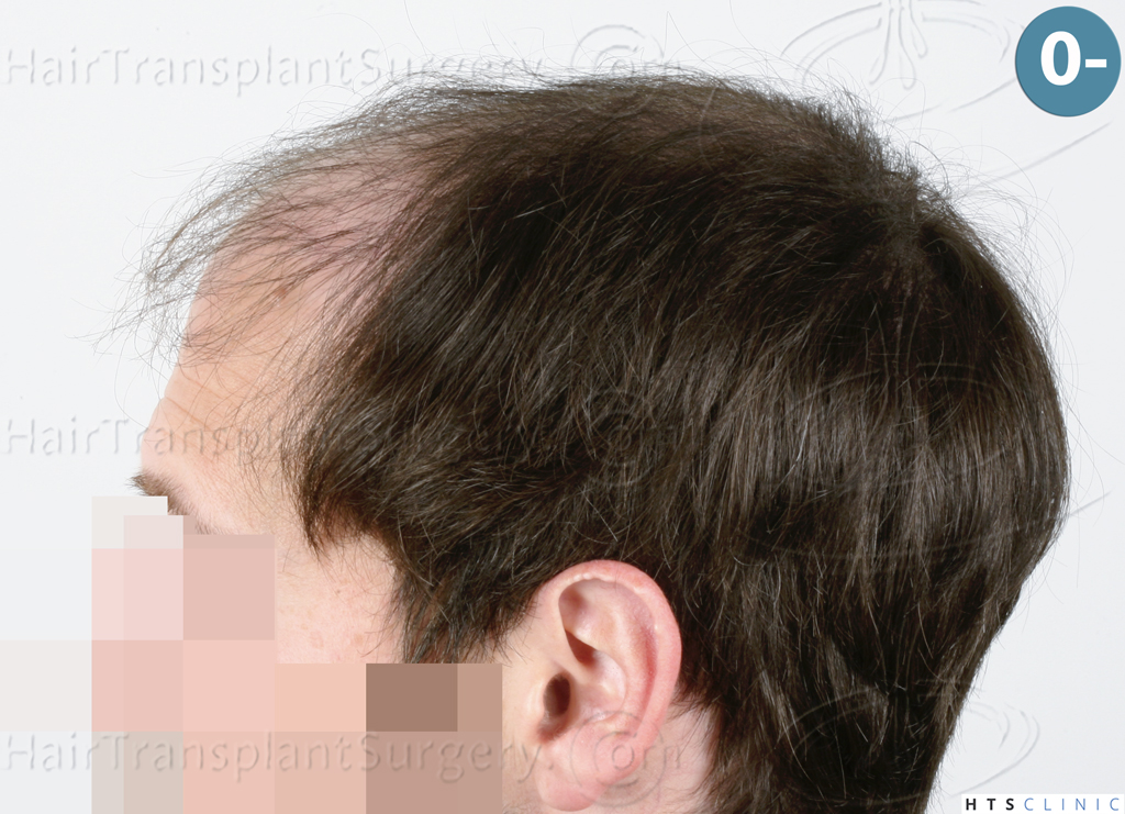 Dr.Devroye-HTS-Clinic-4510-Combo-FUT_FUE-3