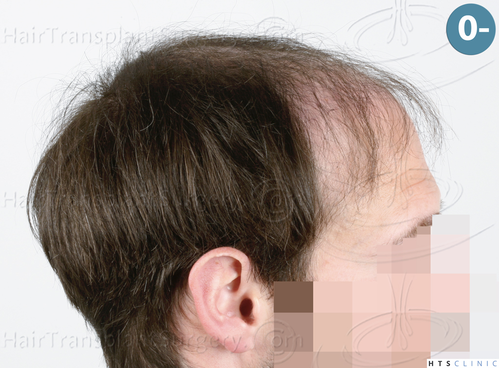 Dr.Devroye-HTS-Clinic-4510-Combo-FUT_FUE-4.jpg