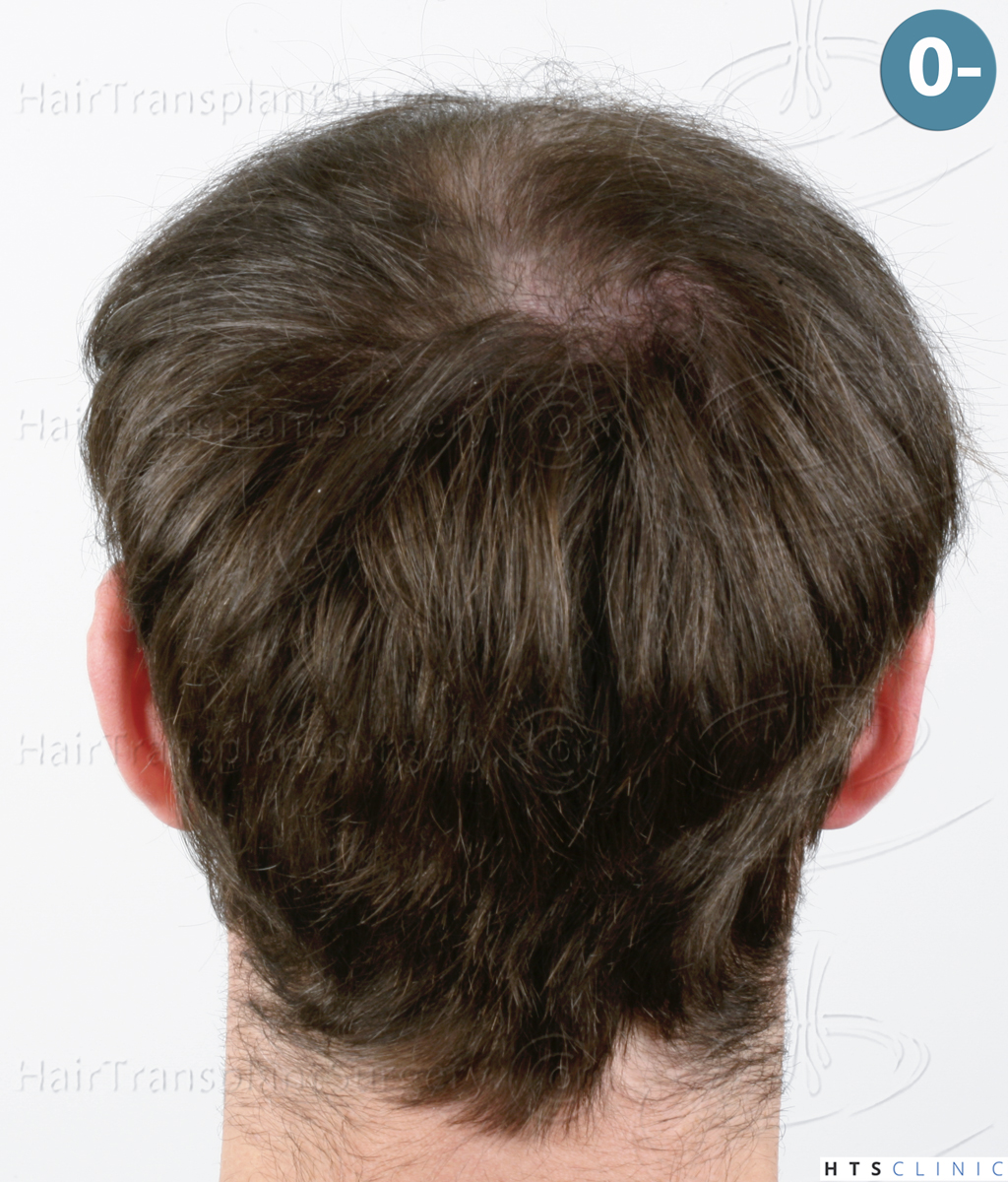 Dr.Devroye-HTS-Clinic-4510-Combo-FUT_FUE-6