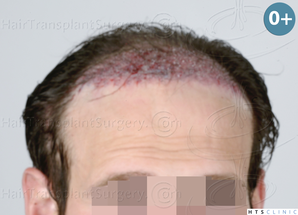 Dr.Devroye-HTS-Clinic-4510-Combo-FUT_FUE-8