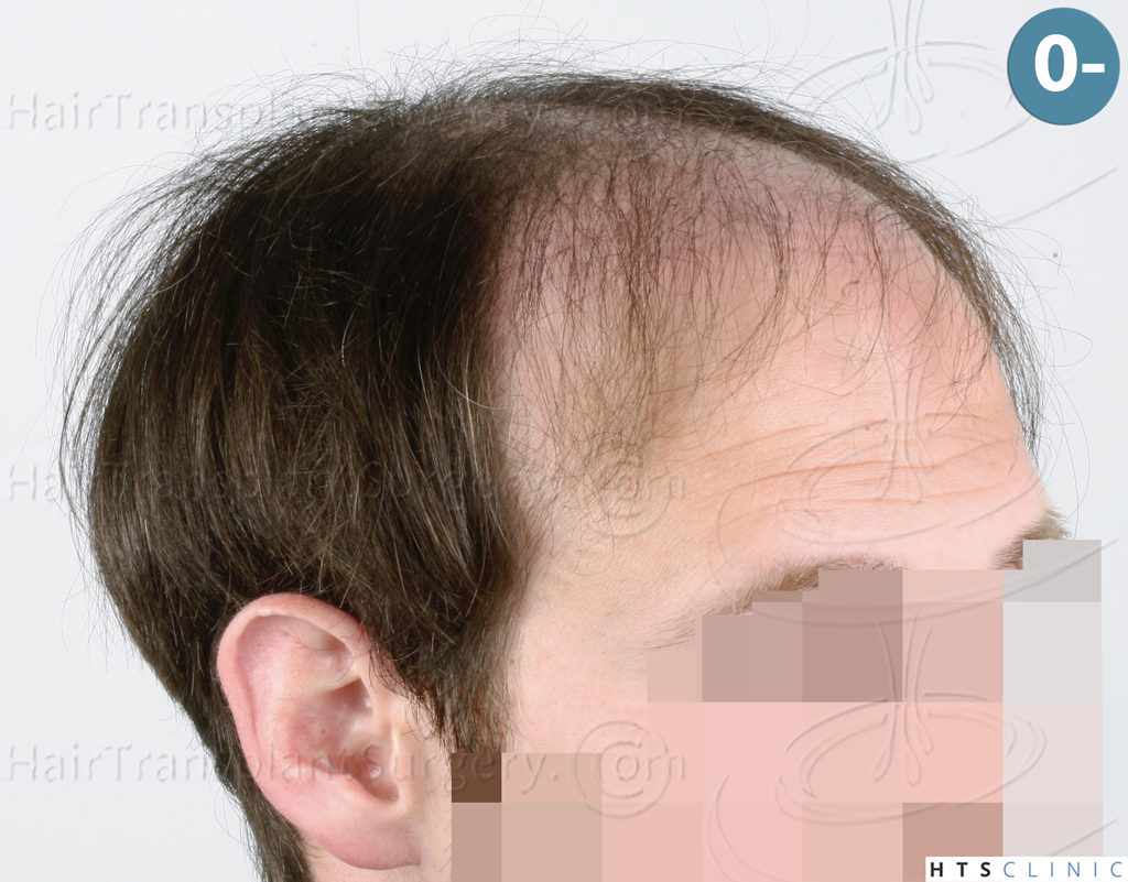 Dr.Devroye-HTS-Clinic-4510-Combo-FUT_FUE-5.jpg