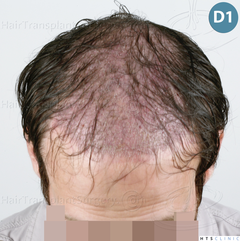 Dr.Devroye-HTS-Clinic-4510-Combo-FUT_FUE-9