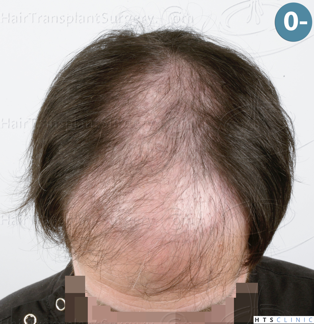 Dr.Devroye-HTS-Clinic-4510-Combo-FUT_FUE-2