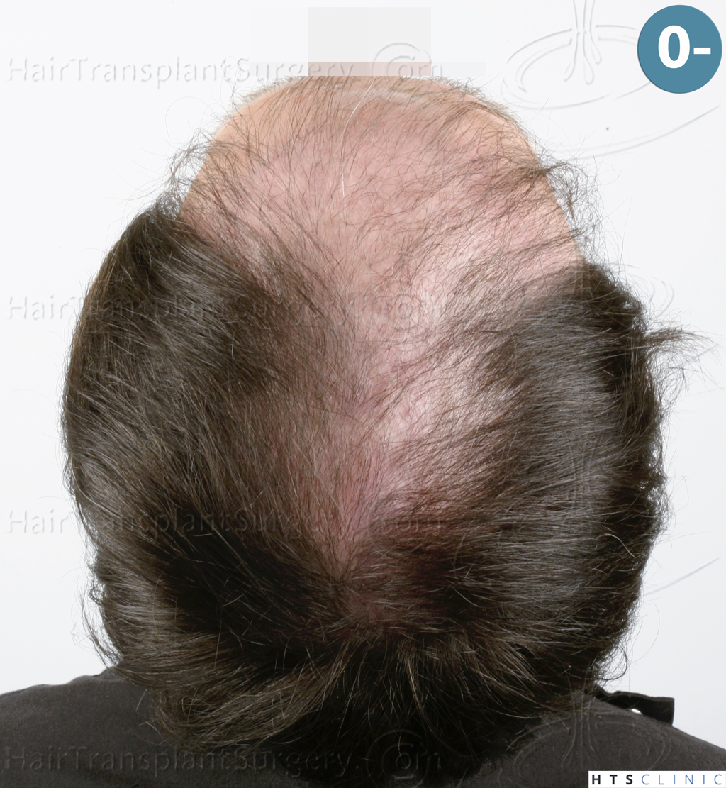 Dr.Devroye-HTS-Clinic-4510-Combo-FUT_FUE-7