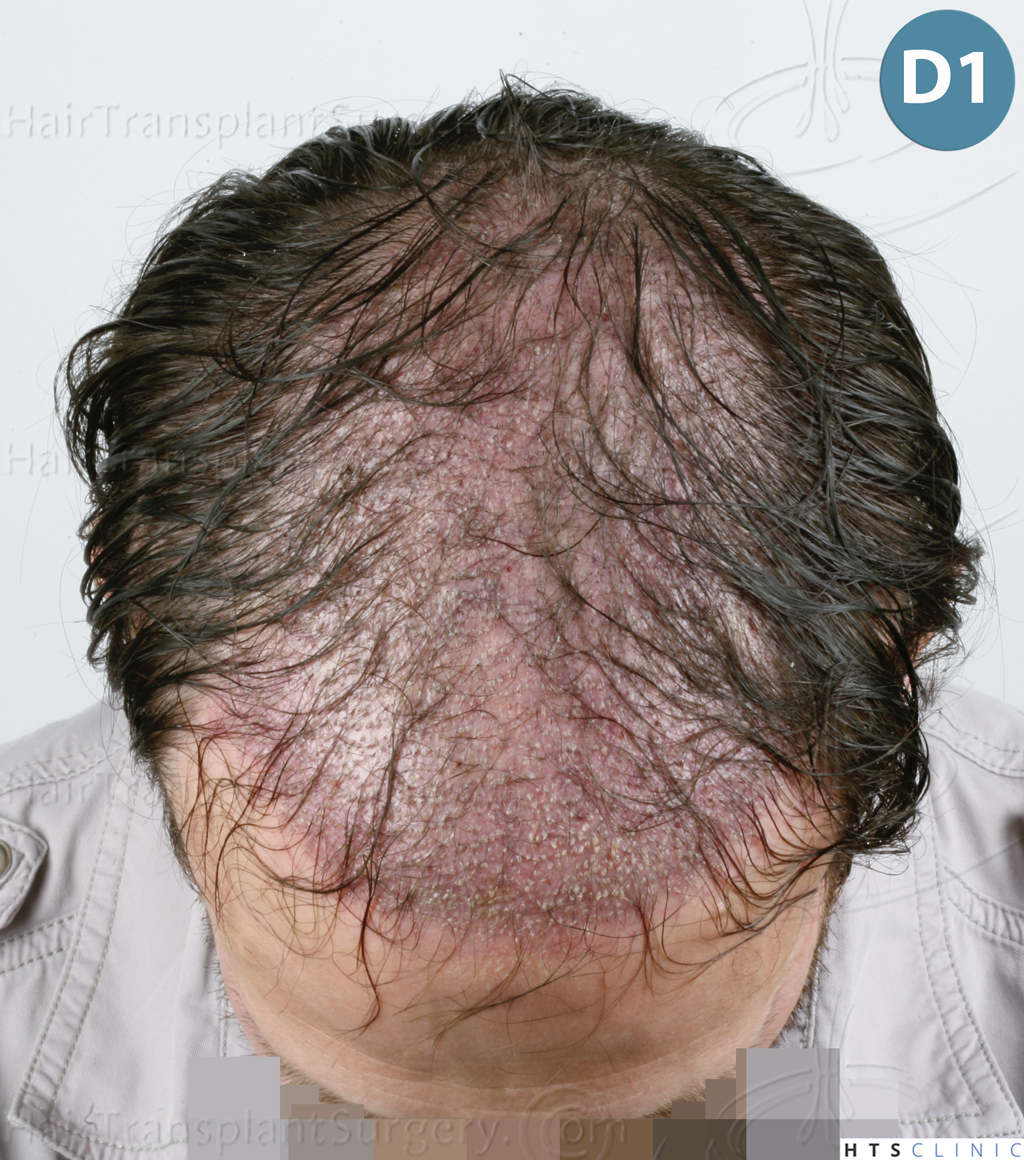 Dr.Devroye-HTS-Clinic-4510-Combo-FUT_FUE-10.jpg