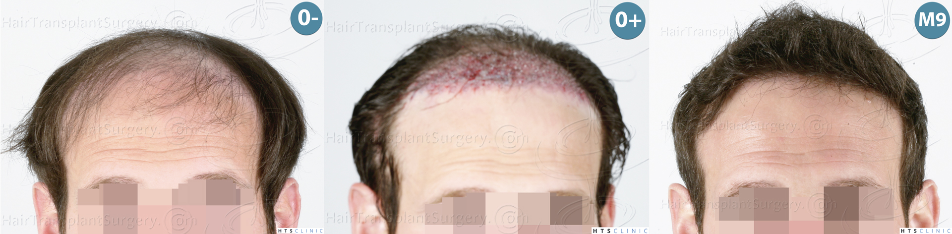 Dr.Devroye-HTS-Clinic-4510-Combo-FUT_FUE