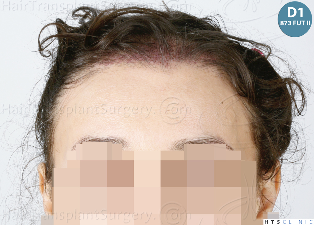 Dr.Devroye-HTS-Clinic-3568-FUT-_2695_873