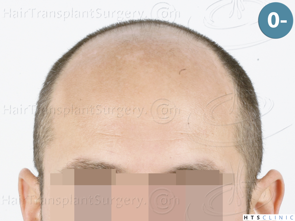 Dr.Devroye-HTS-Clinic-5530-FUE-_3545_198