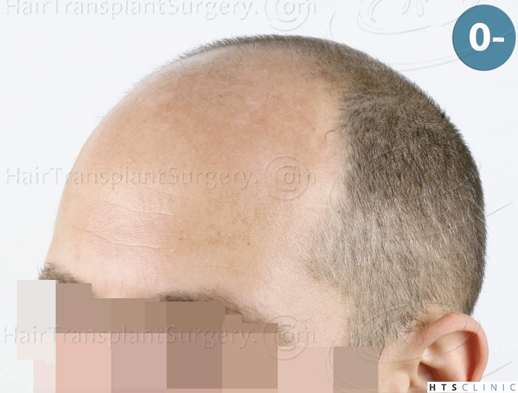 Dr.Devroye-HTS-Clinic-5530-FUE-_3545_198