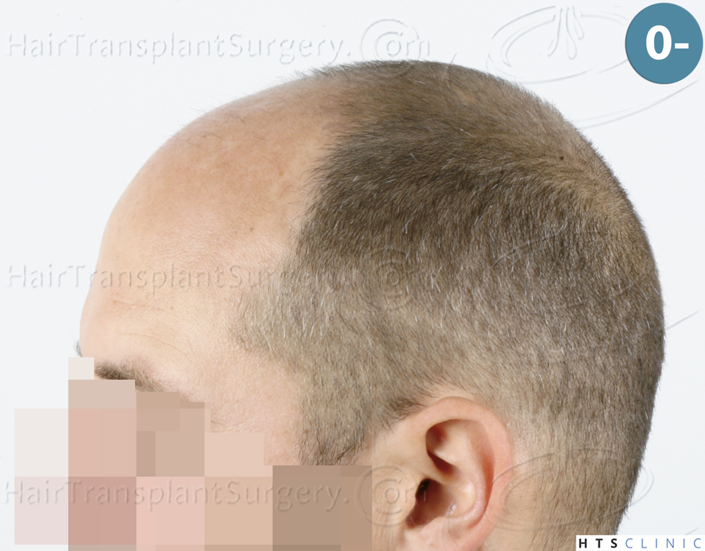 Dr.Devroye-HTS-Clinic-5530-FUE-_3545_198