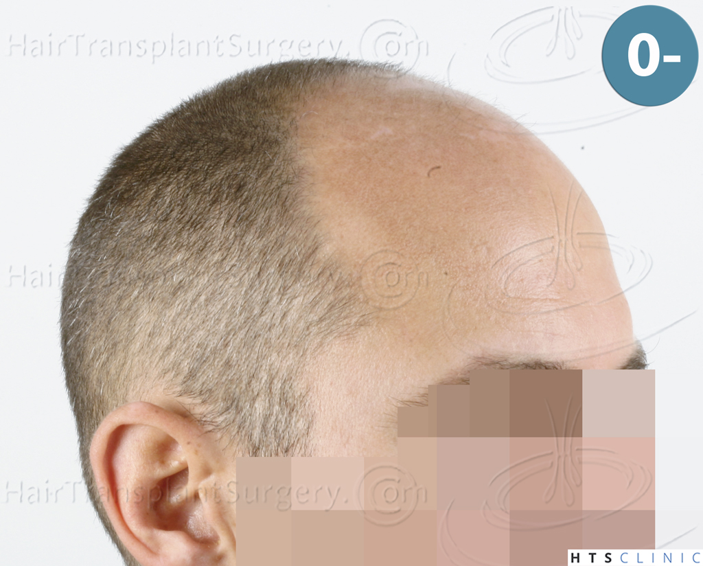 Dr.Devroye-HTS-Clinic-5530-FUE-_3545_198