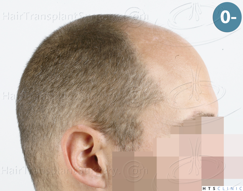 Dr.Devroye-HTS-Clinic-5530-FUE-_3545_198