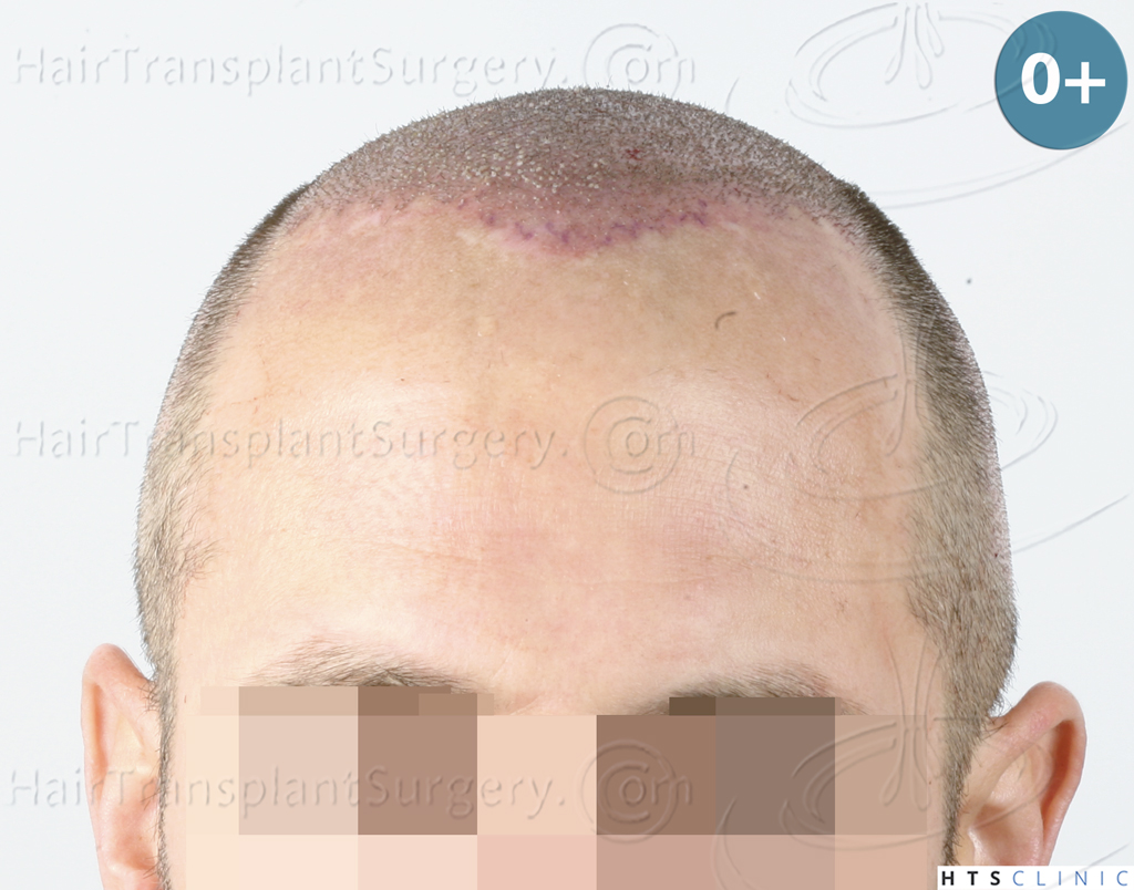 Dr.Devroye-HTS-Clinic-5530-FUE-_3545_198