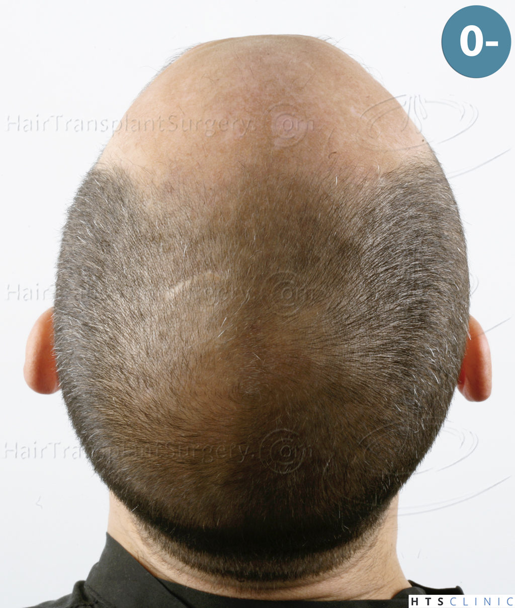 Dr.Devroye-HTS-Clinic-5530-FUE-_3545_198