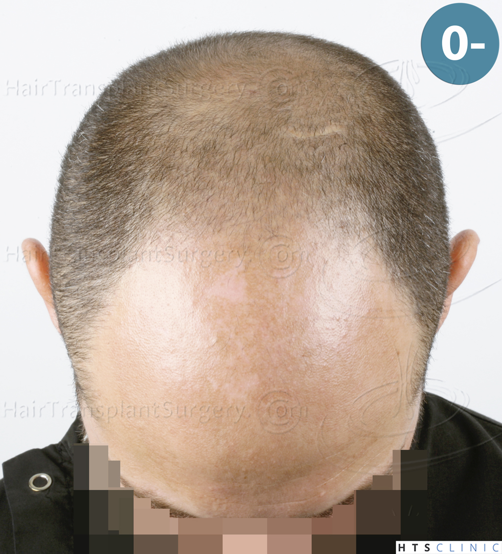 Dr.Devroye-HTS-Clinic-5530-FUE-_3545_198