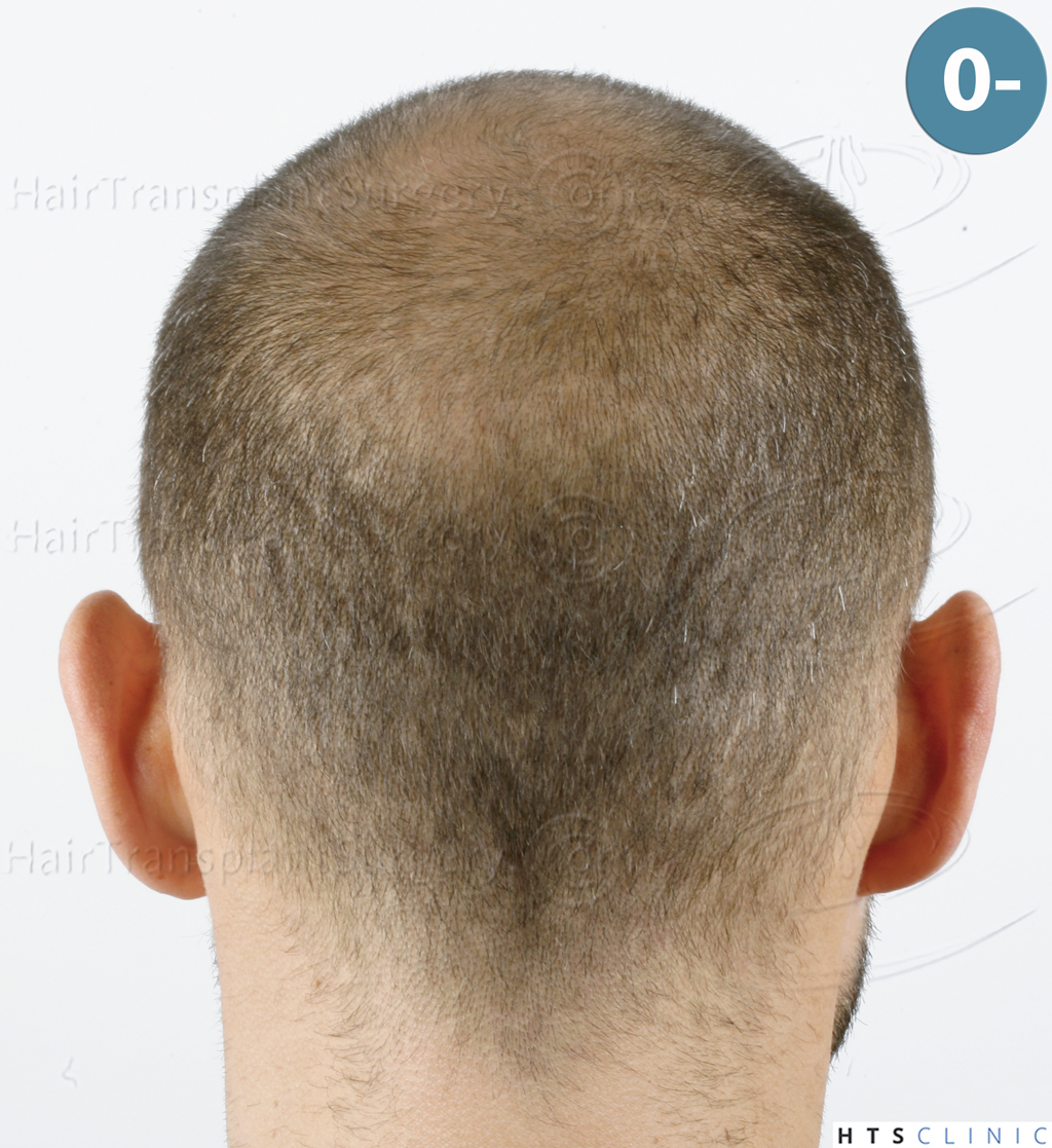 Dr.Devroye-HTS-Clinic-5530-FUE-_3545_198