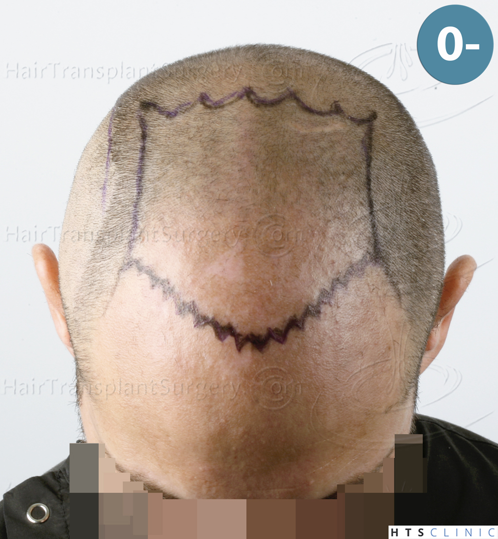 Dr.Devroye-HTS-Clinic-5530-FUE-_3545_198