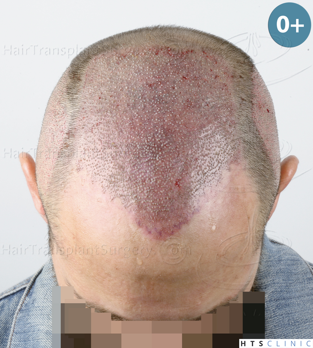 Dr.Devroye-HTS-Clinic-5530-FUE-_3545_198