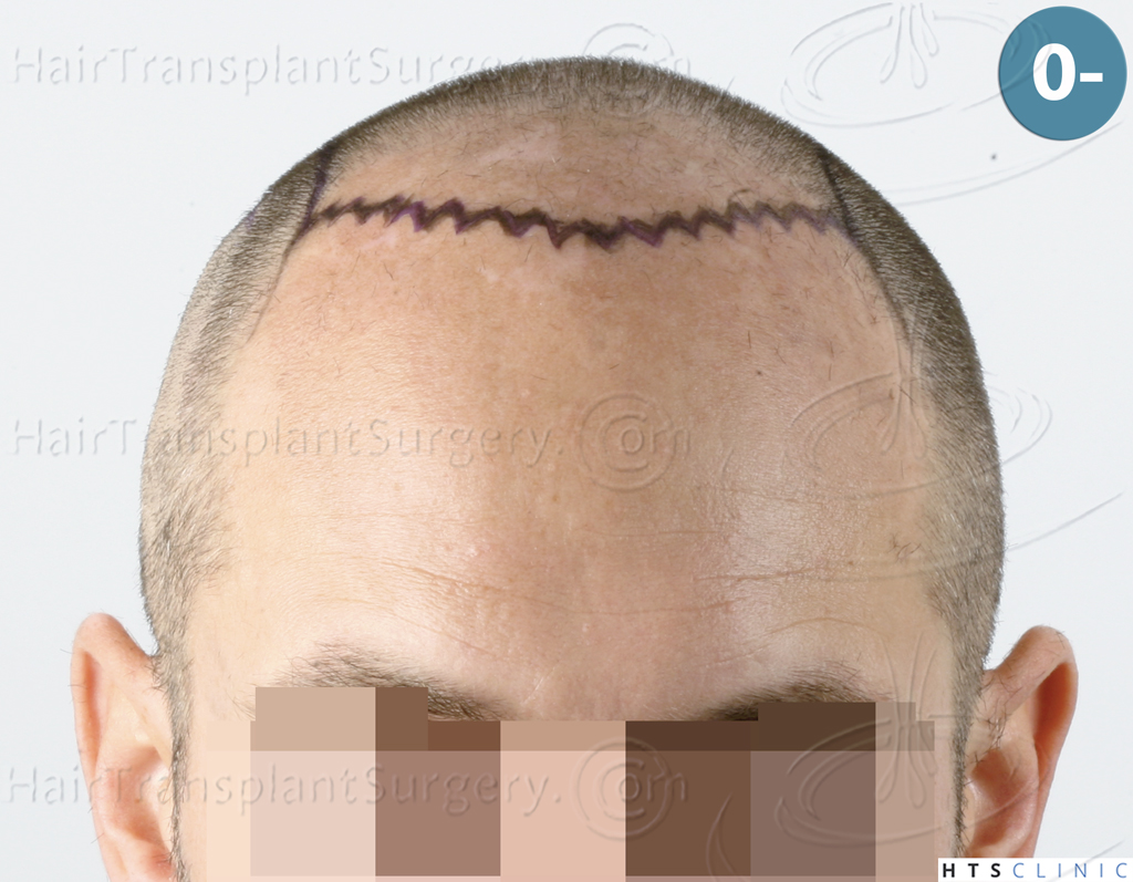 Dr.Devroye-HTS-Clinic-5530-FUE-_3545_198