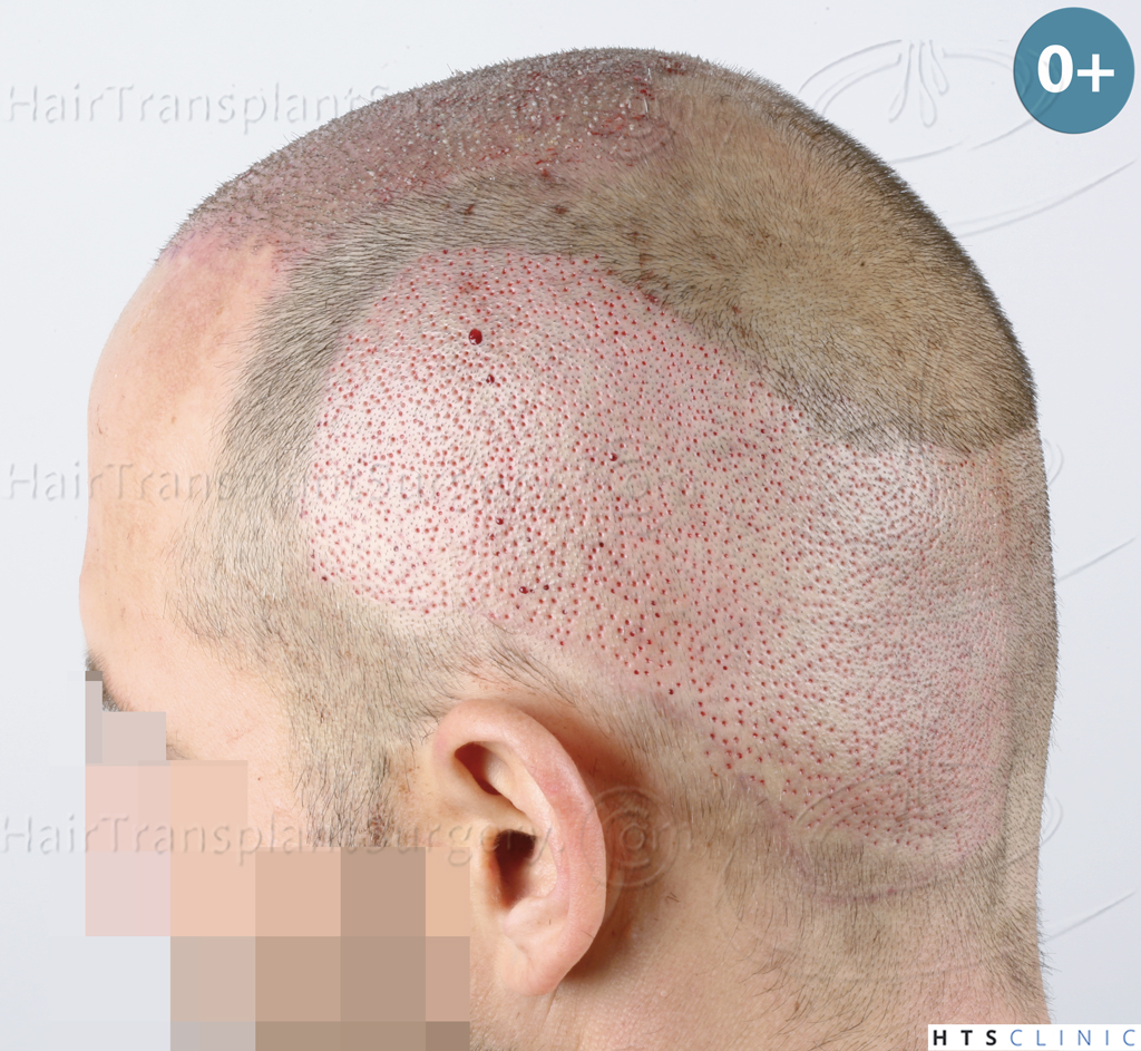 Dr.Devroye-HTS-Clinic-5530-FUE-_3545_198