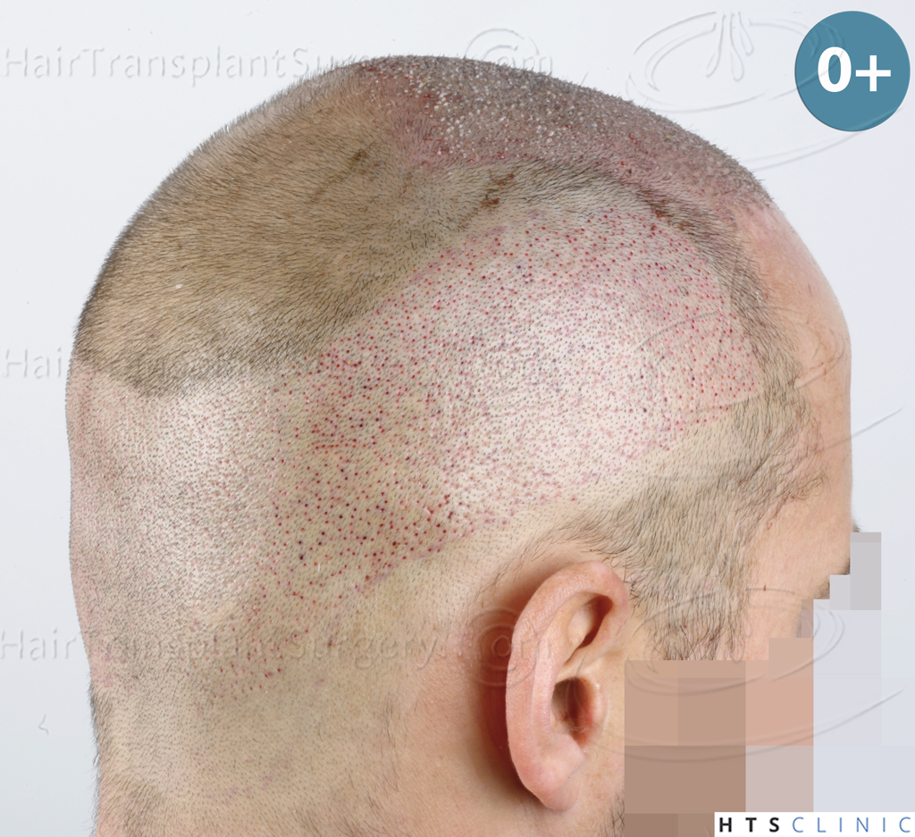 Dr.Devroye-HTS-Clinic-5530-FUE-_3545_198