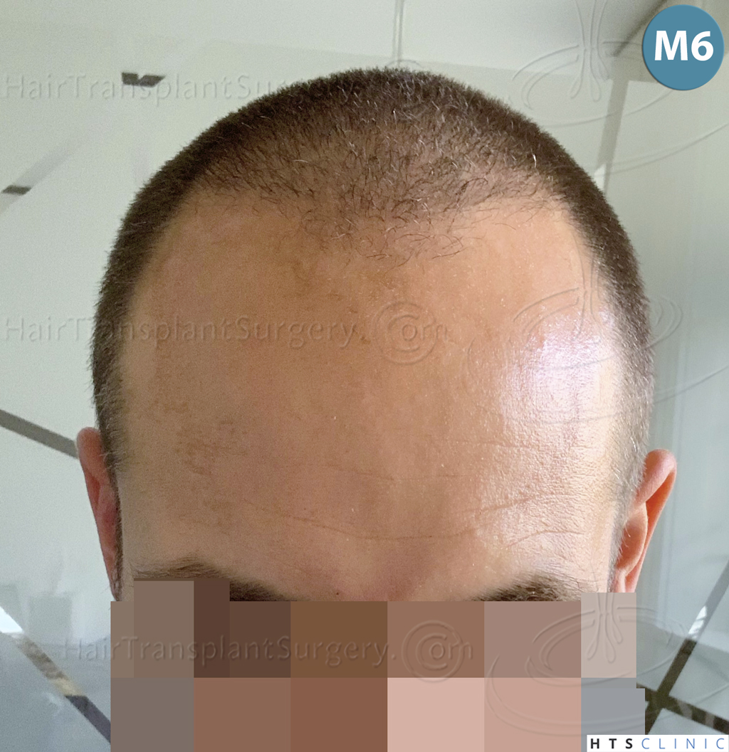 Dr.Devroye-HTS-Clinic-5530-FUE-_3545_198