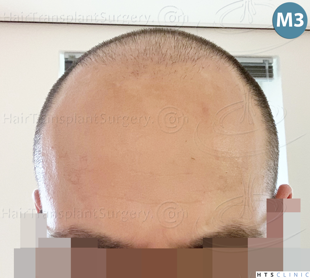 Dr.Devroye-HTS-Clinic-5530-FUE-_3545_198