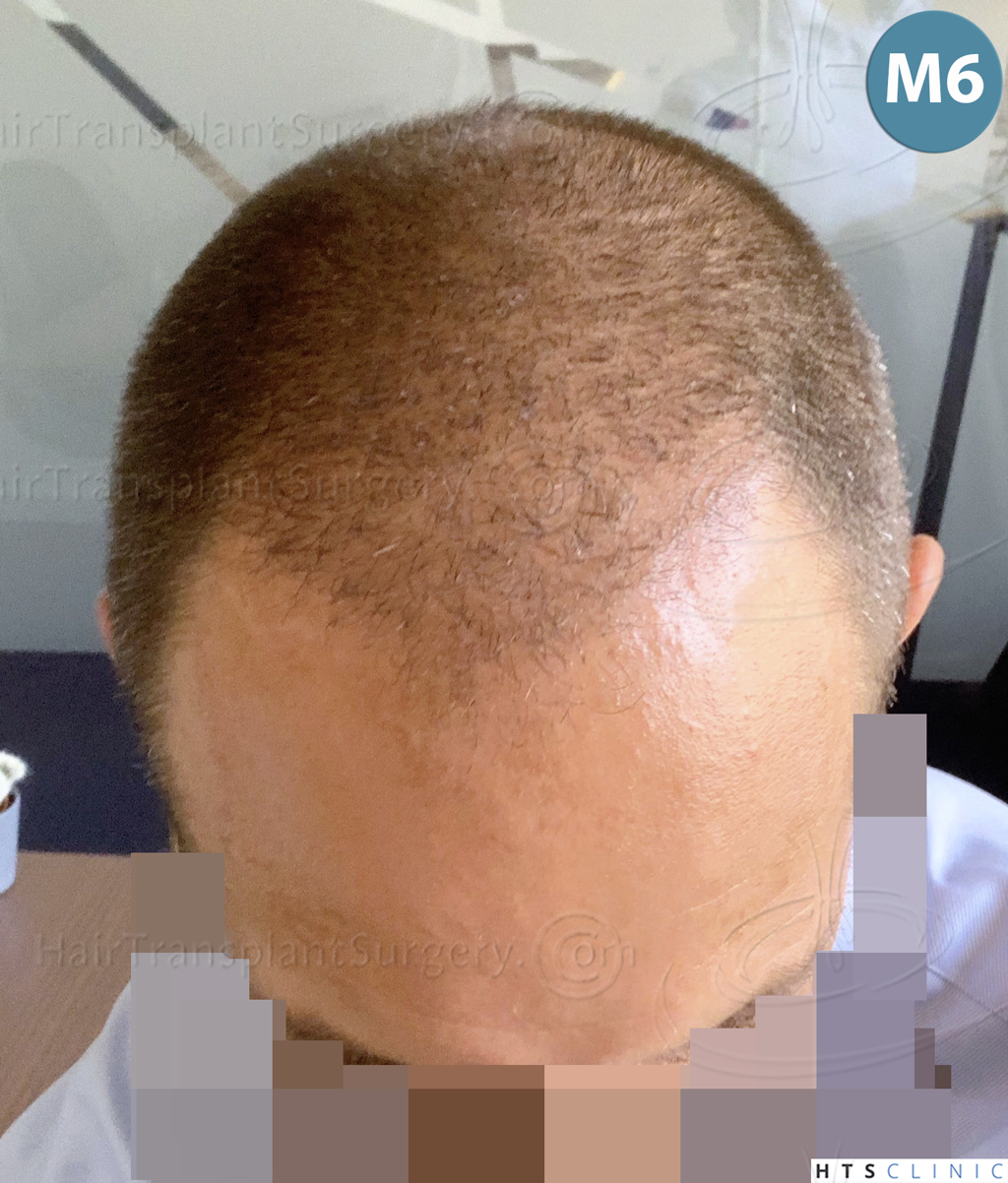 Dr.Devroye-HTS-Clinic-5530-FUE-_3545_198